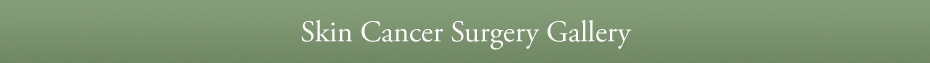 Skin Cancer Surgery Gallery